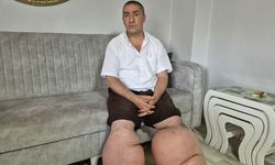 15 yıldır fil hastalığıyla mücadele ediyor