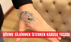 Dövme sildirmek isterken kabusu yaşadı