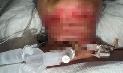 Gıdı estetiği sonrası nefes alamadı, boynundan acil solunum yolu açıldı