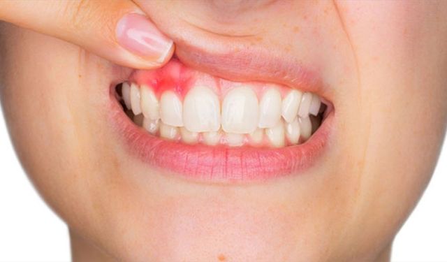 Diş eti problemlerine dikkat, uzmanlar uyarıyor: "Sessiz ilerler"