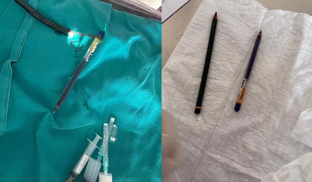Genç kadının midesinden endoskopiyle iki kalem çıkarıldı