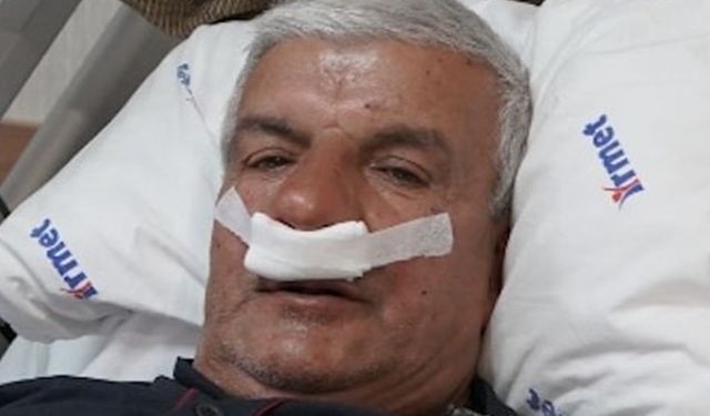 65 yaşındaki adamın burnundan 100 gramlık taş çıkarıldı