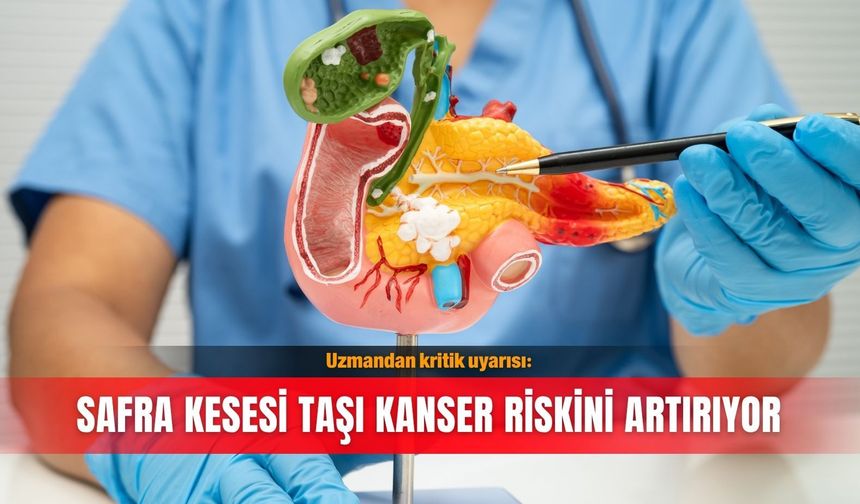 Uzmandan kritik uyarısı: Safra kesesi taşı kanser riskini artırıyor